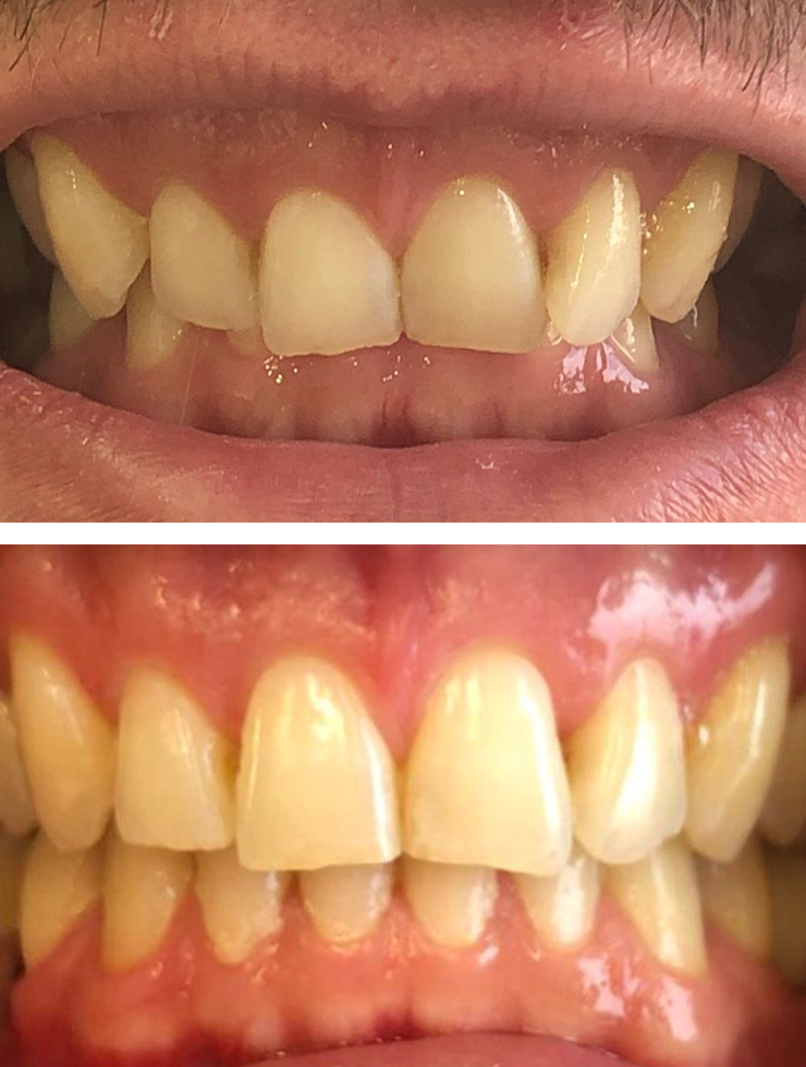 Foto de comparação do antes e depois do Tratamento Invisalign© realizado pela Dra. Larissa Martini (CRO 119343)