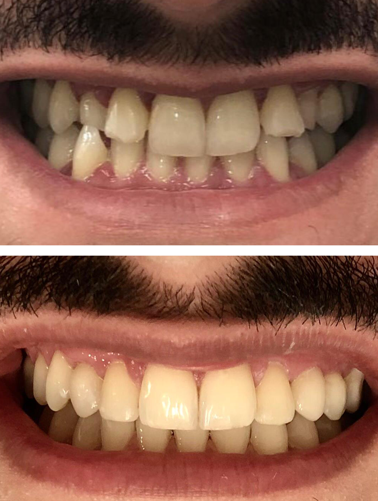 Foto de comparação do antes e depois do Tratamento Invisalign© realizado pela Dra. Larissa Martini (CRO 119343)