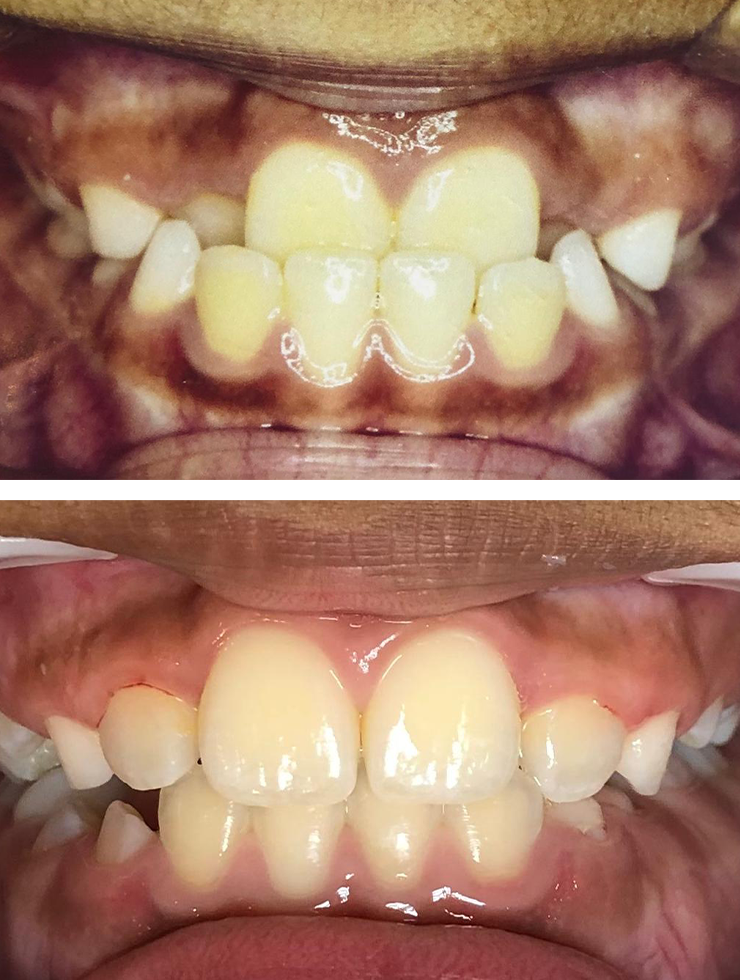 Foto de comparação do antes e depois do Tratamento Invisalign© realizado pela Dra. Larissa Martini (CRO 119343)