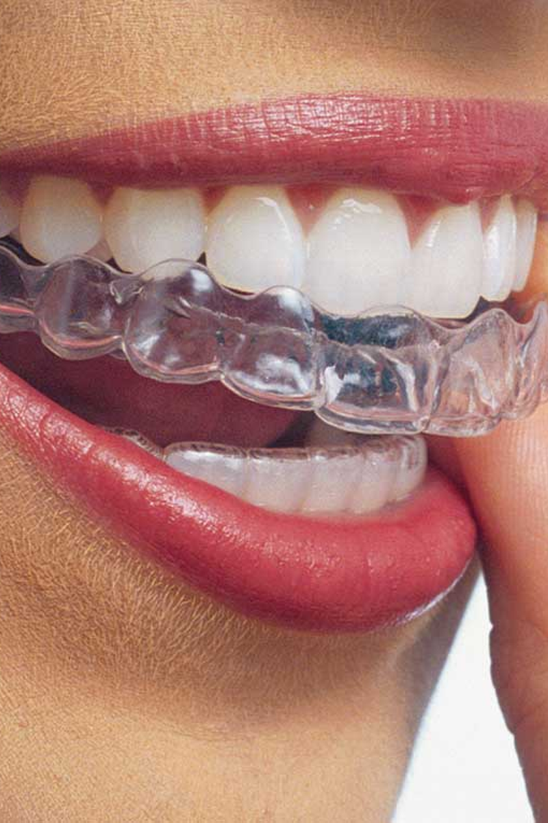 Foto de uma paciente utilizando o aparelho Invisalign©